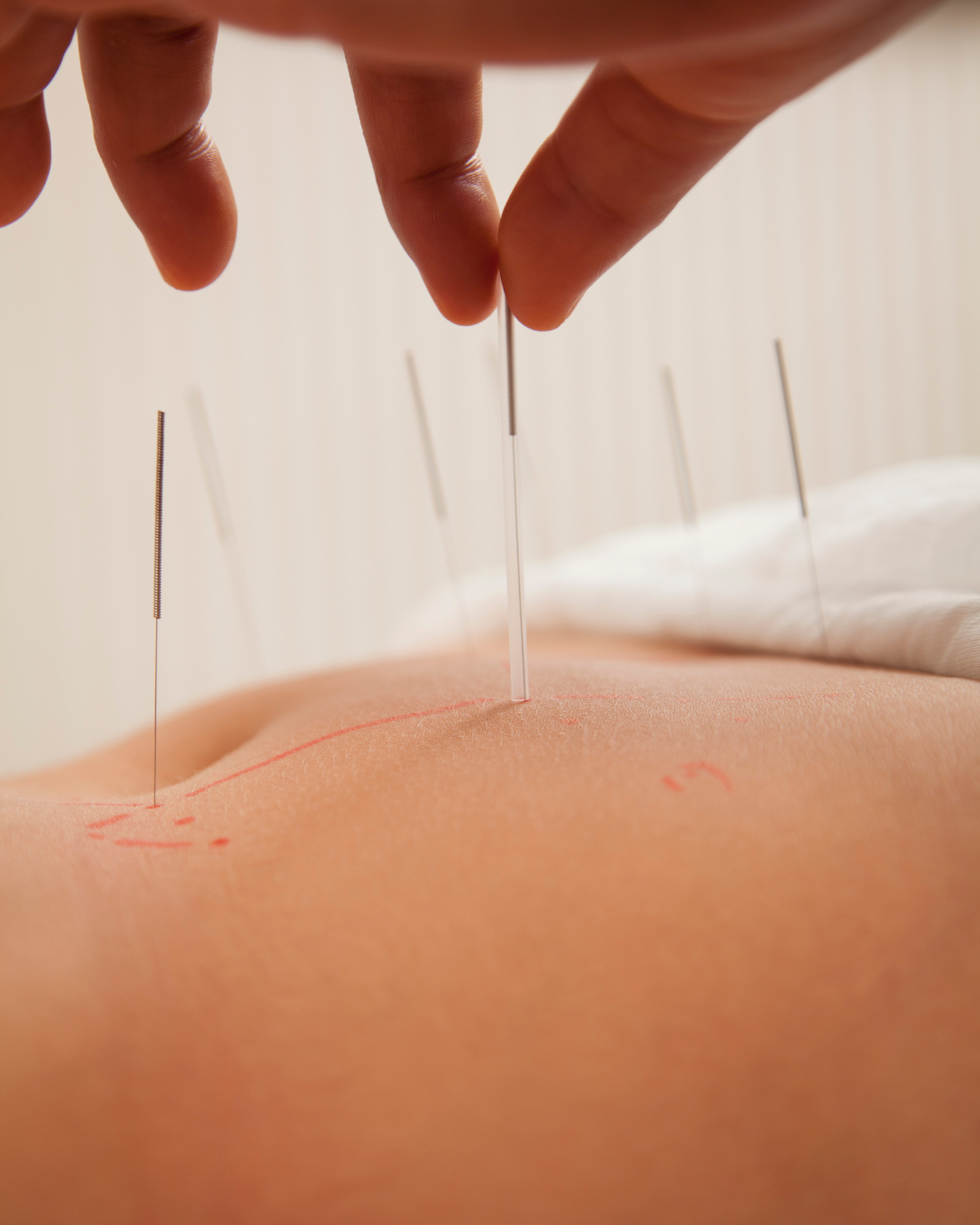 Acupuncture Bedford NS
