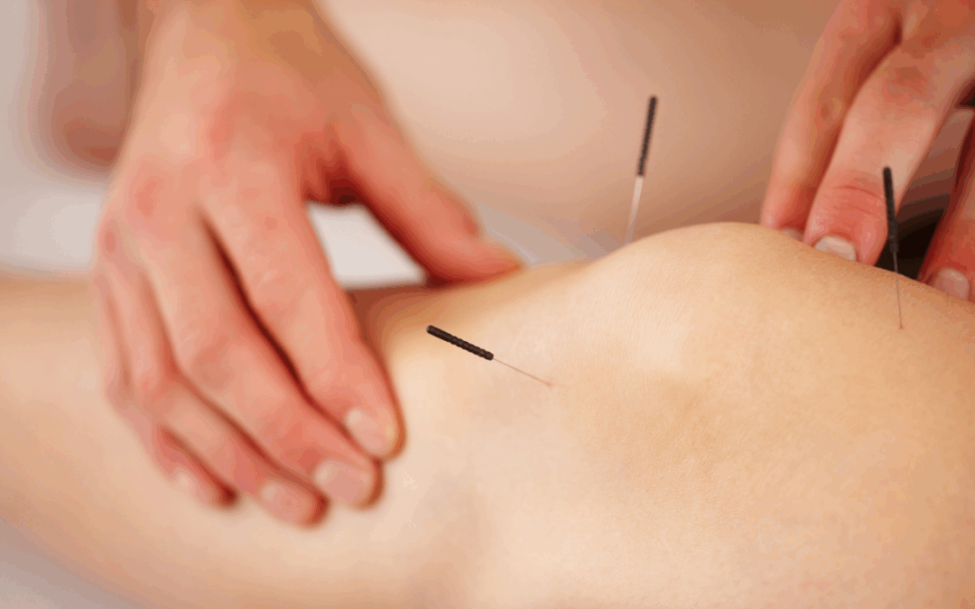 Understanding TCM and Acupuncture in NB