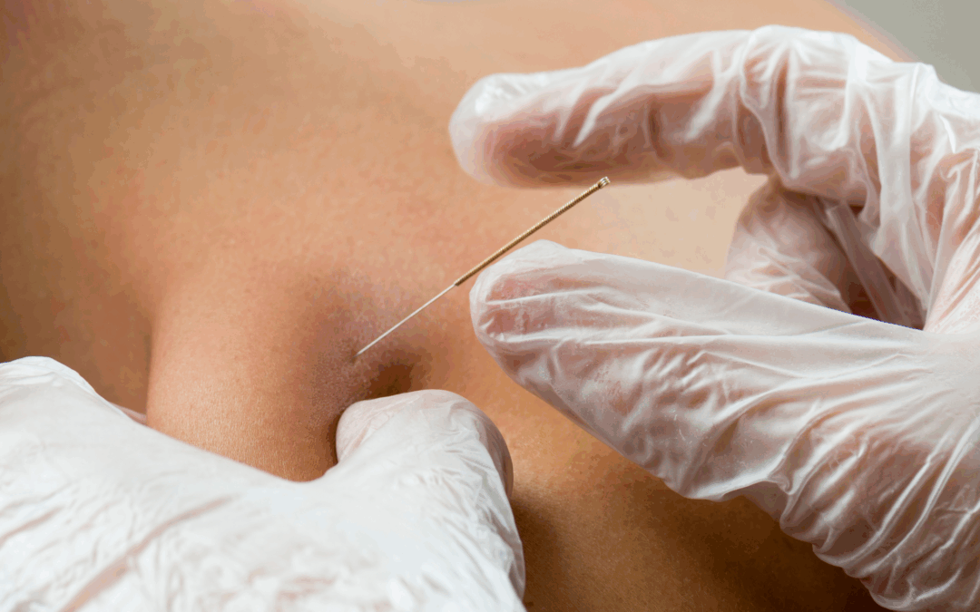 You Can Stick a Needle in Someone and Call It Acupuncture — But That Doesn’t Make It Acupuncture