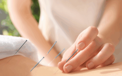 Acupuncture in Bedford, NS: How to Book at the CCATCM Student Clinic