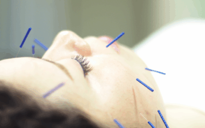 Can I Get Cosmetic Acupuncture If I Have Botox and Fillers?