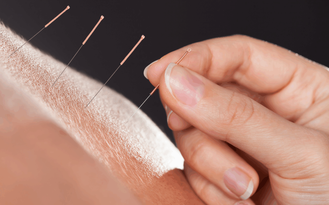 What Acupuncture Really Feels Like, Honestly