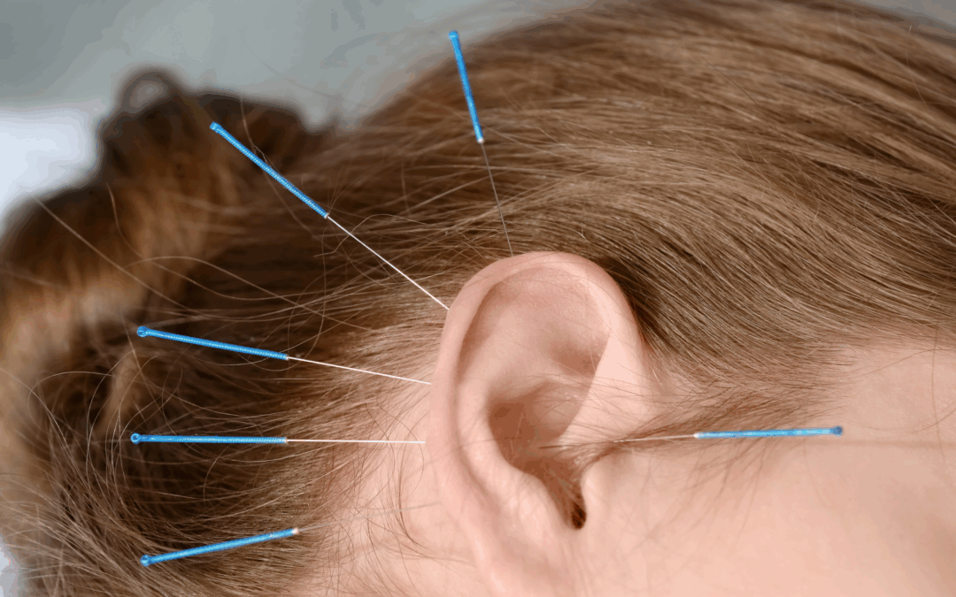 17 Questions Every Woman Has About Acupuncture but Never Asks Out Loud