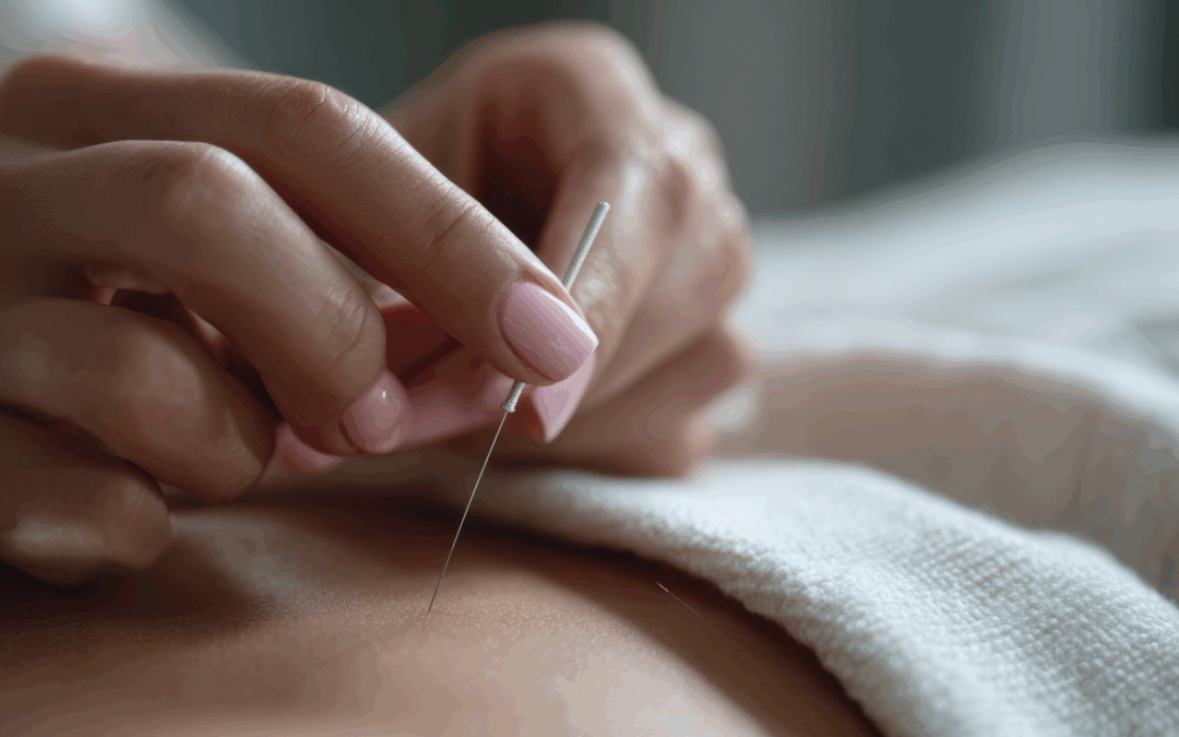 Acupuncture needle gently inserted during a relaxing treatment for stress and anxiety in Bedford, Nova Scotia